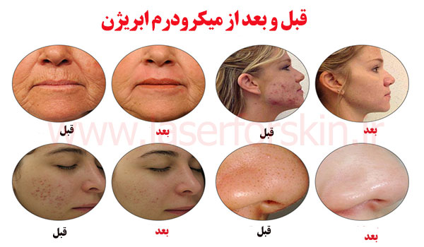 قیمت دستگاه میکرودرم ابریژن کلینیکی