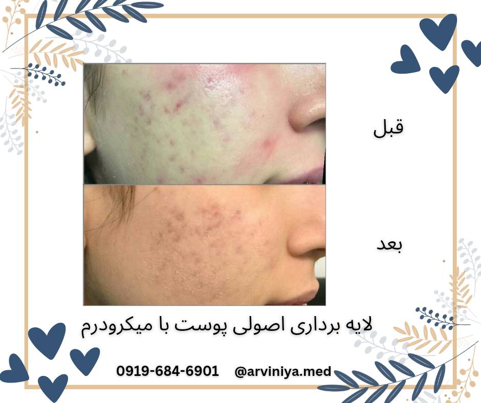 عرضه انواع دستگاه های میکرودرم