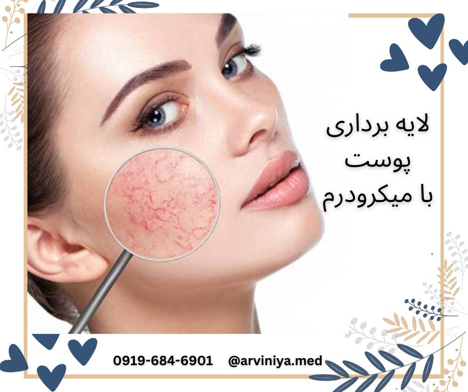 عرضه انواع دستگاه های میکرودرم