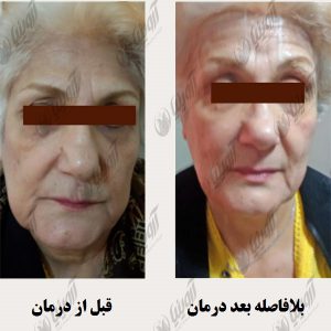 مرکز فروش انواع دستگاه هایفوتراپی