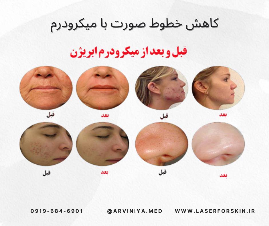 فروش دستگاه میکرودرم سالنی