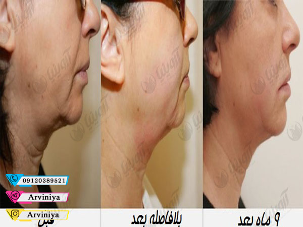 قیمت دستگاه هایفو کلینیکی