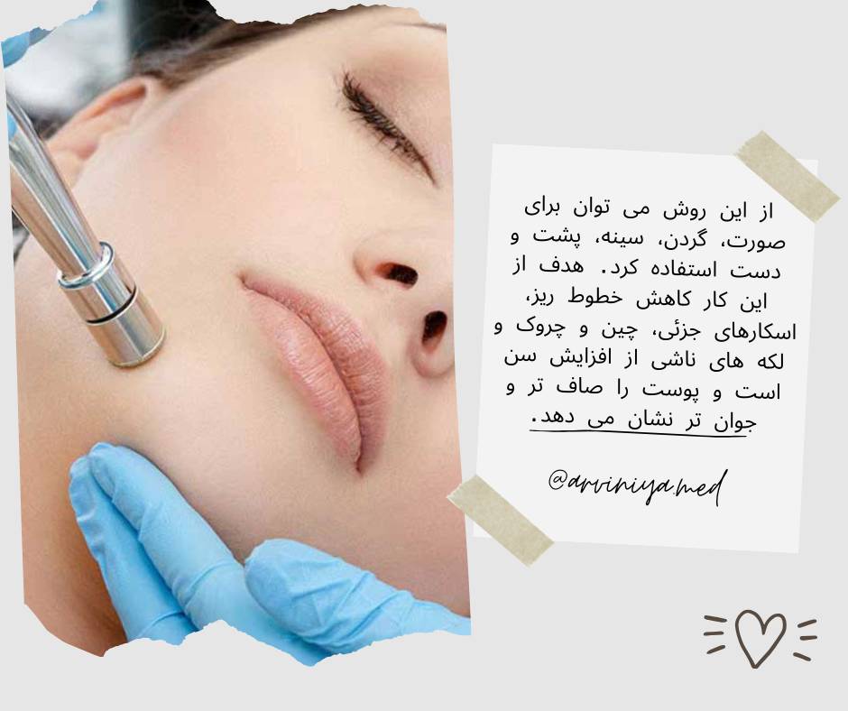 ویژگی های دستگاه میکرودرم طب مکس