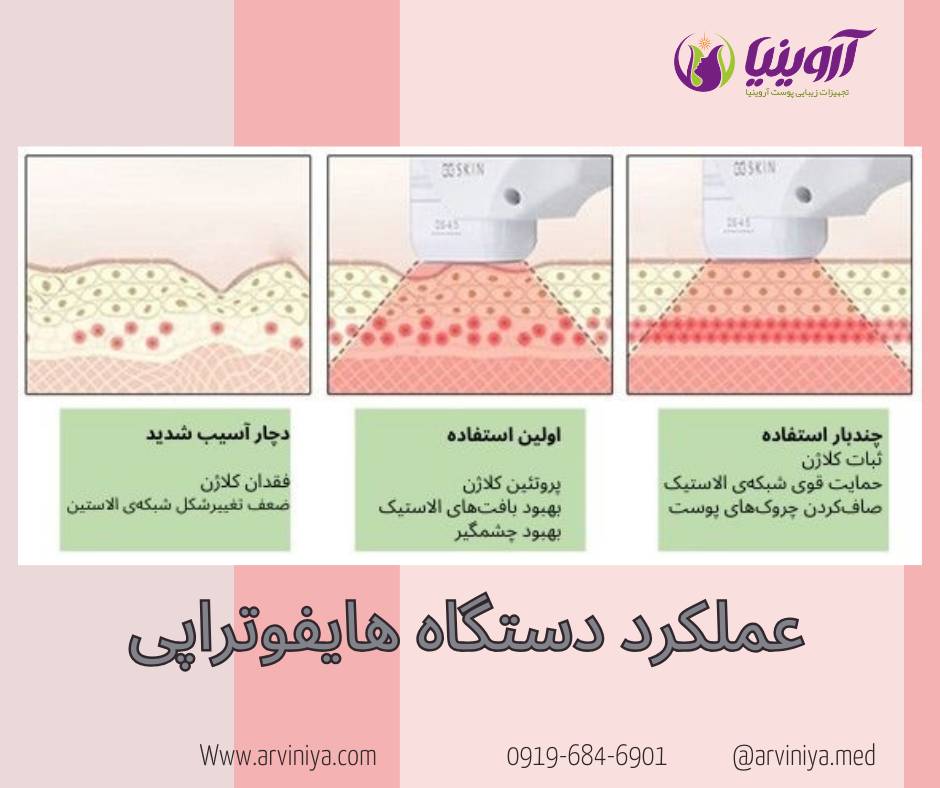 عملکرد دستگاه هایفو تراپی