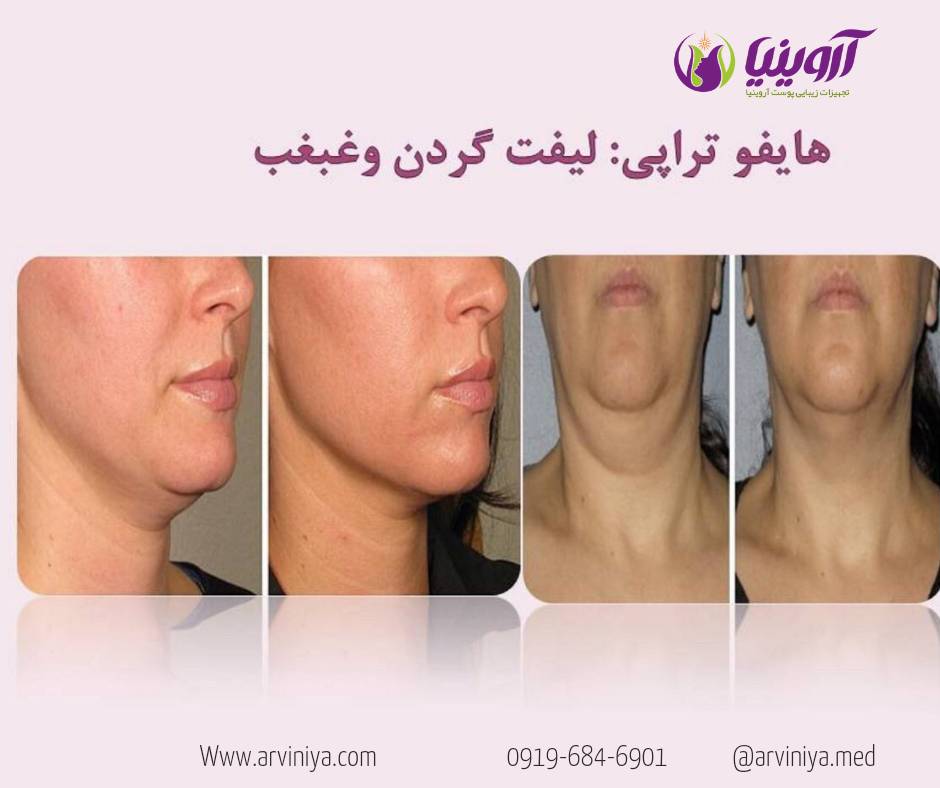 کاربردهای دستگاه هایفوتراپی