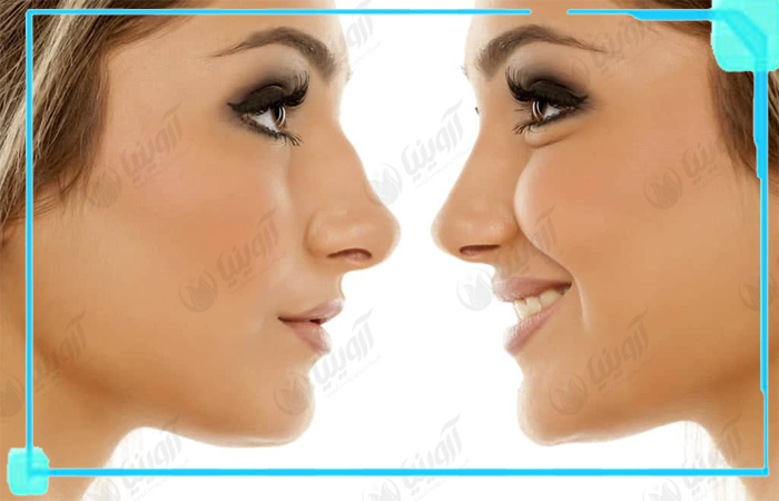 تخفیف ویژه خرید دستگاه پلاسما جت فایربولت