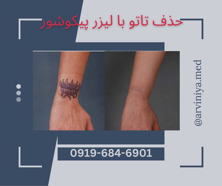 قیمت خرید ویژه دستگاه لیزر پیکوشور