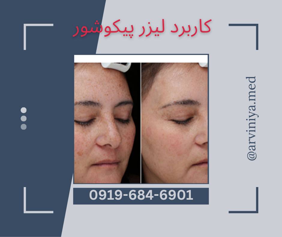 قیمت خرید ویژه دستگاه لیزر پیکوشور