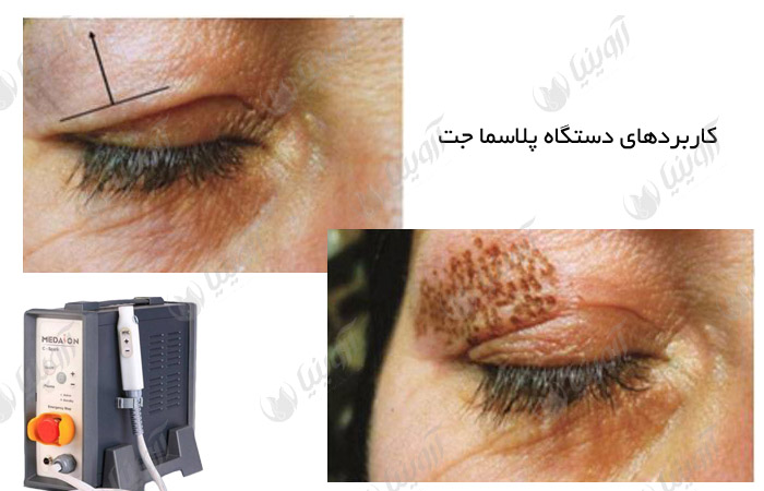 خرید بهترین مارک دستگاه پلاسما جت کلینیکی