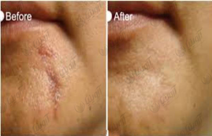 قیمت فروش دستگاه کربوکسی تراپی صورت