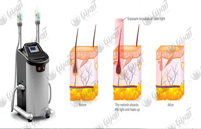 قیمت دستگاه لیزر آی پی ال IPL رومیزی