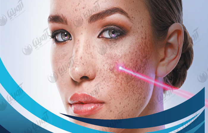 قیمت دستگاه لیزر کیوسوئیچ مدل کره ای و چینی