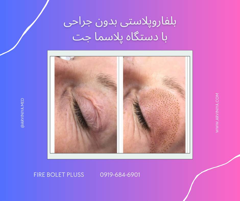 قیمت دستگاه پلاسما جت فایربولت پلاس