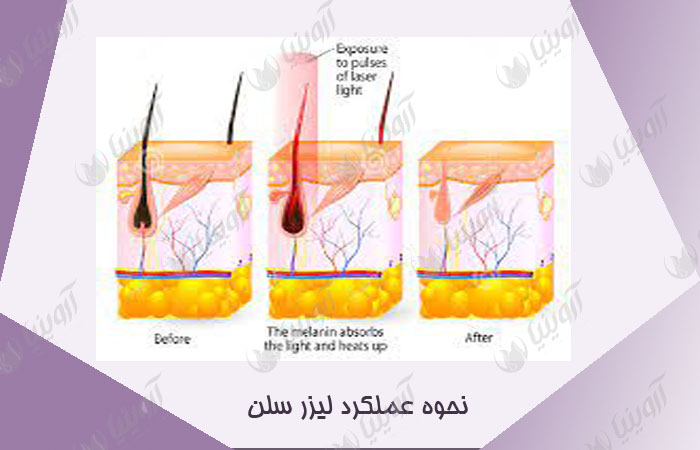 قیمت دستگاه لیزر سلن