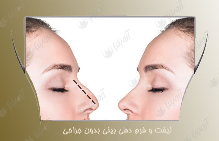 قیمت دستگاه پلاسما جت پلاروکس