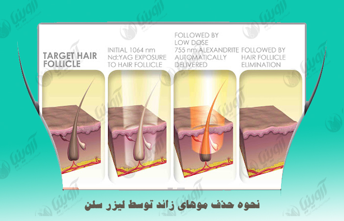 قیمت لیزر دایود سلن