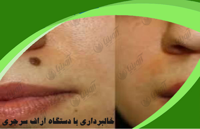 خرید دستگاه آراف سرجیکال
