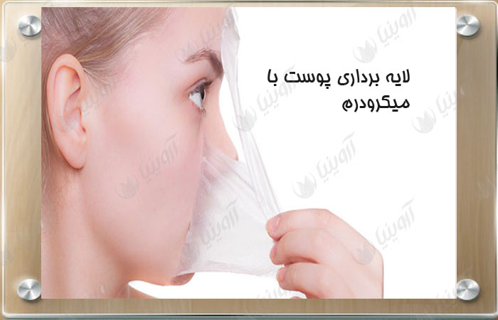 خرید دستگاه میکرودرم آنالوگ