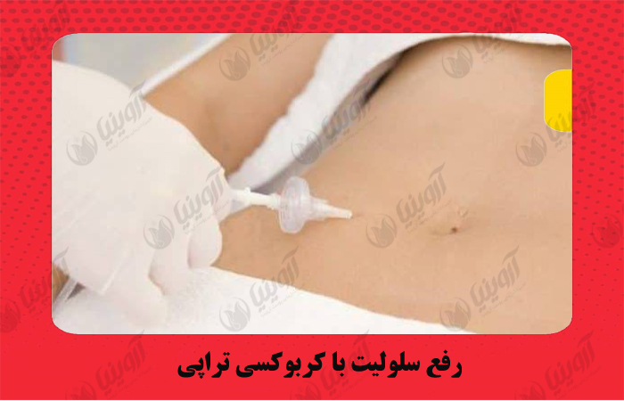 خرید دستگاه کربوکسی تراپی پالوما