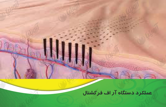 فروش دستگاه آراف فرکشنال