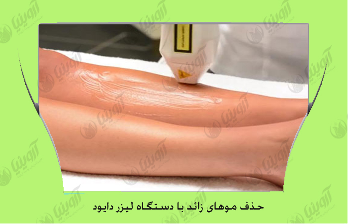 فروش دستگاه لیزر گلکسی