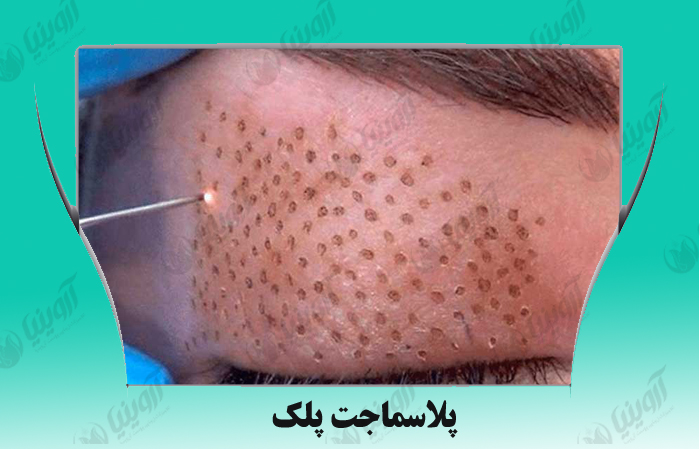 قیمت جدیدترین دستگاه پلاسما