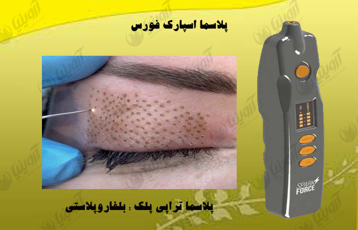 قیمت دستگاه پلاسما فورس