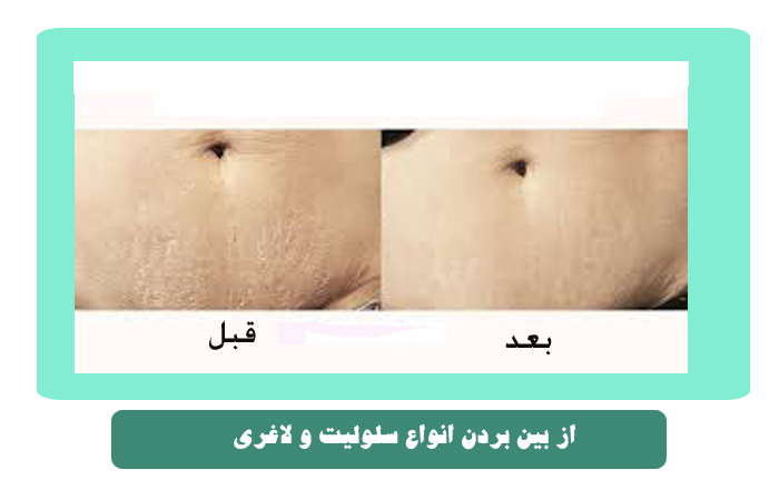 خرید دستگاه کربوکسی تراپی