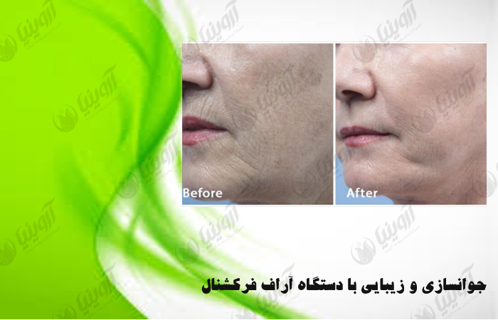 قیمت بهترین دستگاه لیزر آر اف فرکشنال