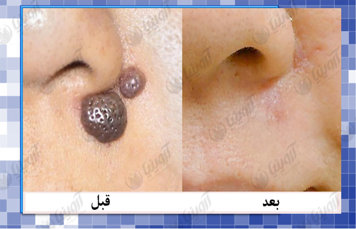 فروش دستگاه آراف خالبرداری