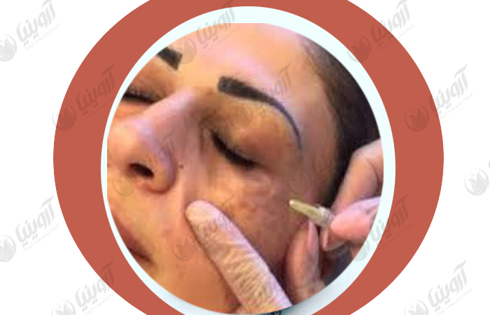 فروش دستگاه کربوکسی تراپی