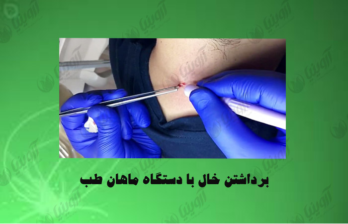 قیمت دستگاه خال برداری
