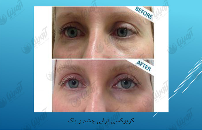 قیمت دستگاه کربوکسی پالوما