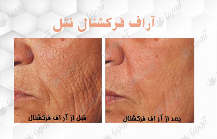 قیمت دستگاه آراف نتل