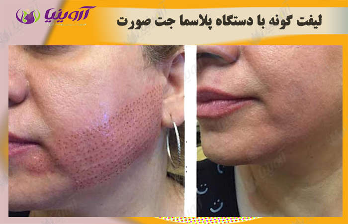 قیمت دستگاه پلاسما صورت