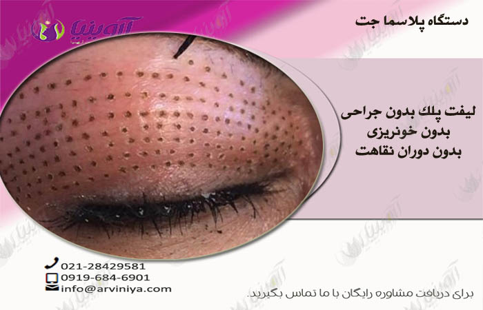 لیست قیمت دستگاه پلاسما جت