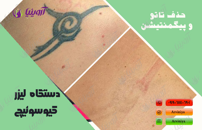 خرید دستگاه لیزر کیوسوئیچ