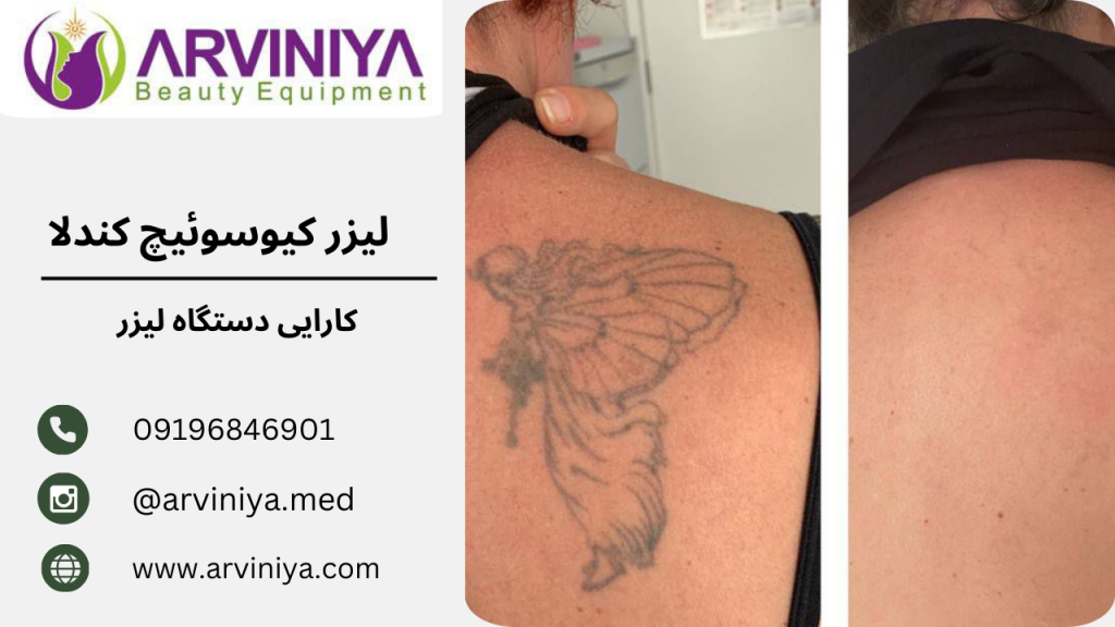 قیمت دستگاه لیزر تاتو کیوسوئیچ