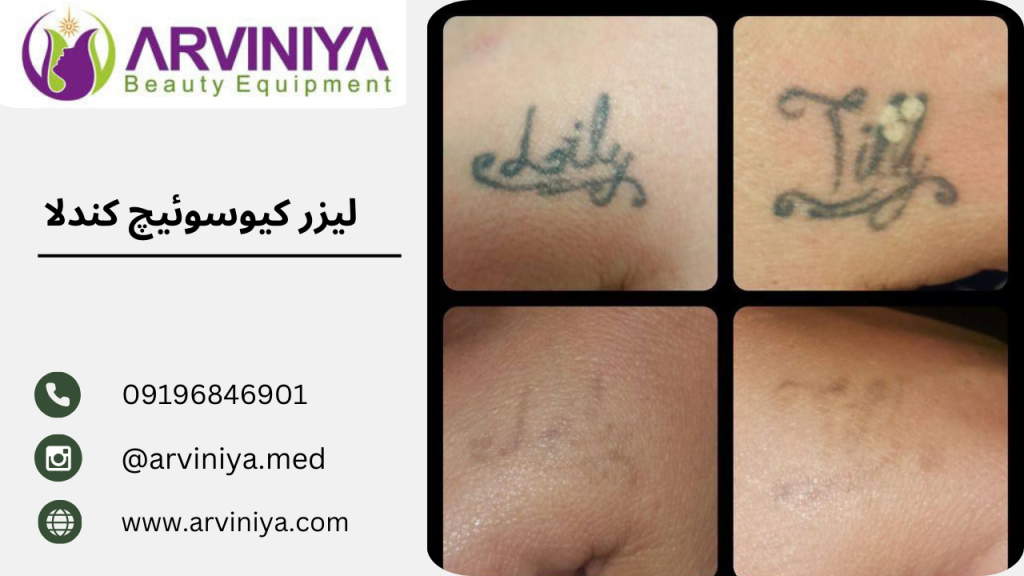 قیمت دستگاه لیزر تاتو کیوسوئیچ