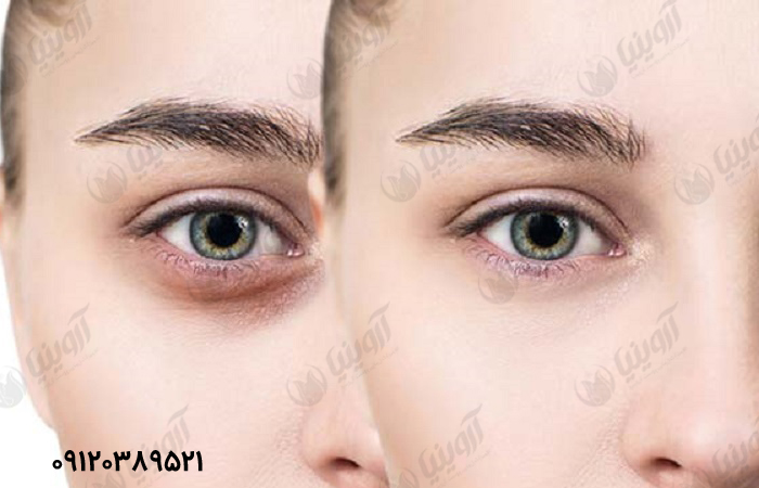 خرید و قیمت بهترین انواع کربوکسی1