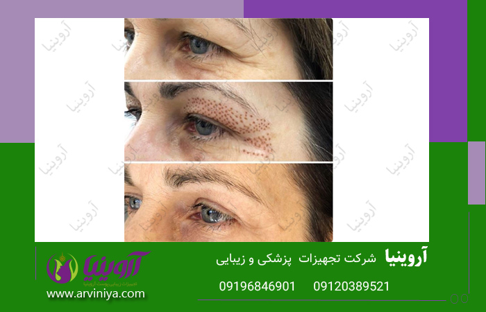 خرید جدیدترین انواع دستگاه پلاسما جت کلینیکی