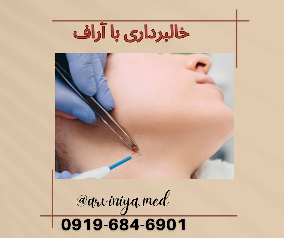 جدیدترین دستگاه آر اف سرجری 