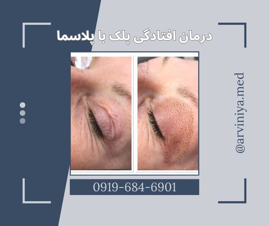 انواع دستگاه پلاسما جت برای خرید