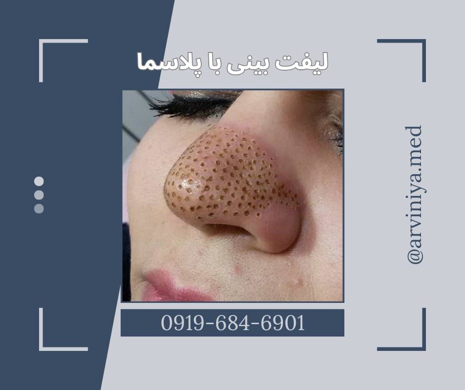 انواع دستگاه پلاسما جت برای خرید
