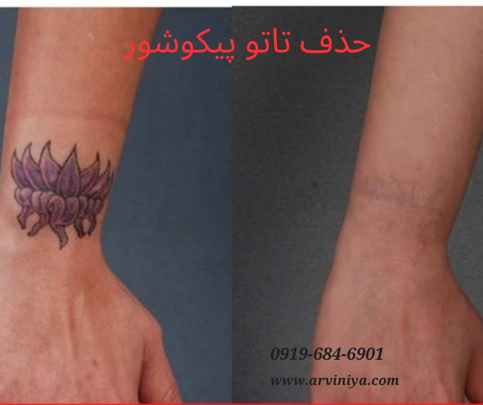 قیمت خرید دستگاه لیزر پیکوشور