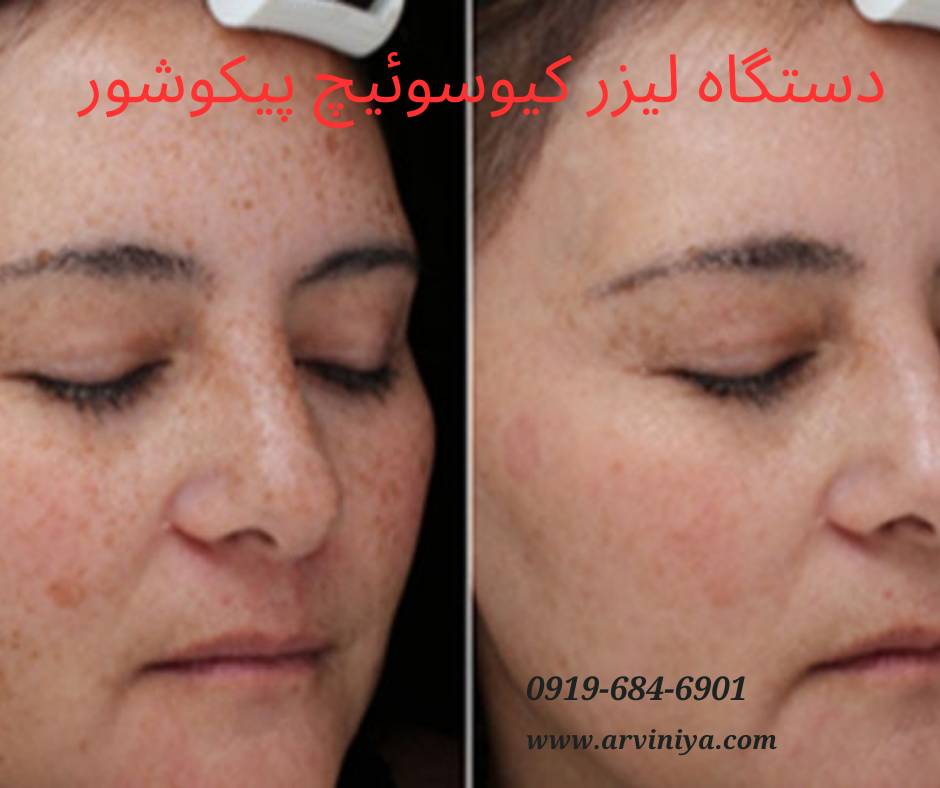 قیمت خرید دستگاه لیزر پیکوشور