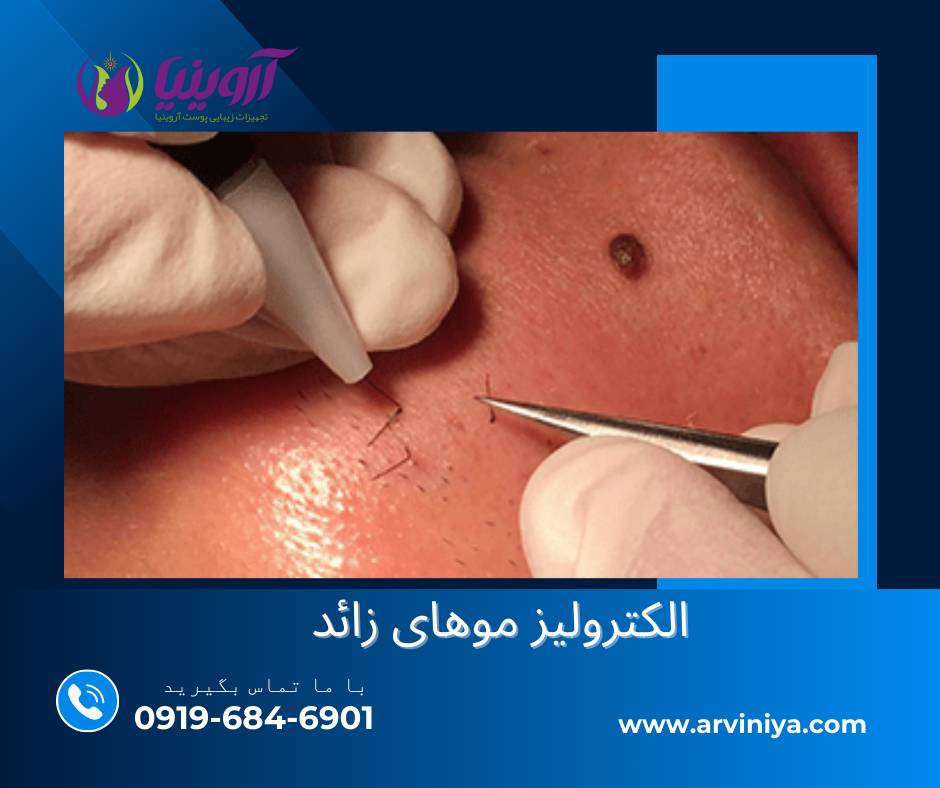 قیمت و خرید دستگاه الکترولیز دیجیتال موهای زائد