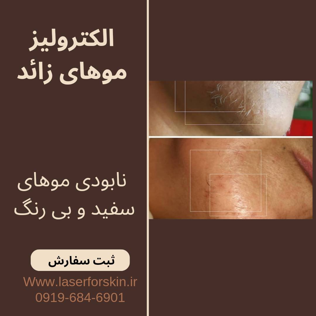 دستگاه الکترولیز اتوماتیک و ساده استارمکس بیوتی star max