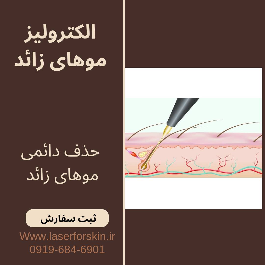 دستگاه الکترولیز اتوماتیک و ساده استارمکس بیوتی star max