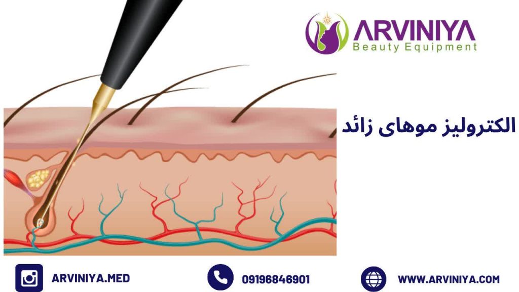 الکترولیز موهای زائد